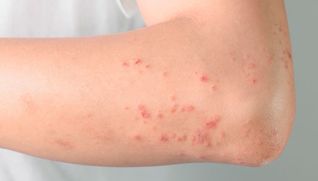 Dermatología